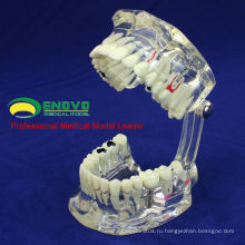 DENTAL08(12567) прозрачный зубной имплантат болезни зубы модели с восстановление